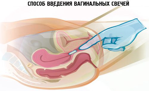 Способ введения вагинальных свечей