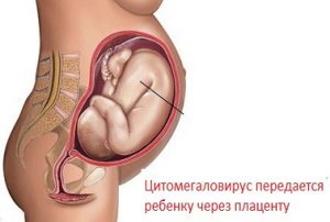 Цитомегаловирус при беременности