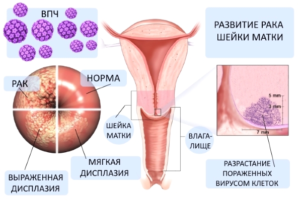  ВПЧ и рак шейки матки 