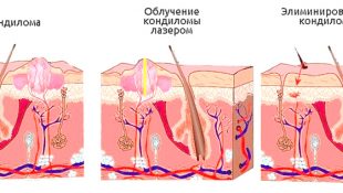 Схема удаления кондиломы