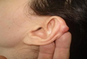 Папиллома на внешней стороне уха