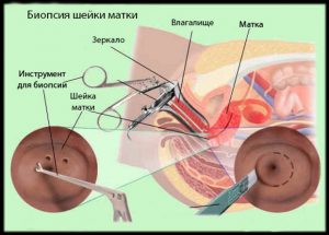 Схема биопсии шейки матки