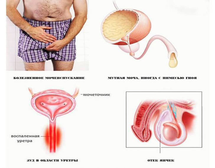 Схематическое изображение поражения мужских органов при гонорее