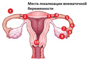 Локализация внематочной беременности