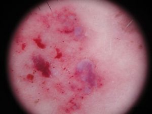 Криоглобулинемическая пурпура