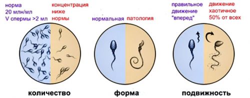 Патологии сперматозоидов