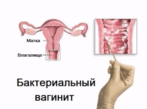Схема бактериального вагинита