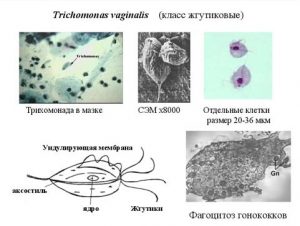 Trichomonas vaginalis