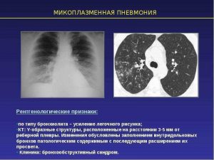 Микоплазменная пневмония
