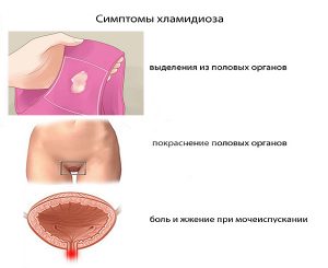 Основные симптомы хронического хламидиоза