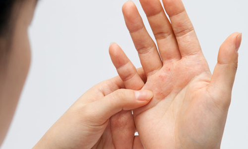 Чесотка на руках: особенности проявления, лечение, диагностика