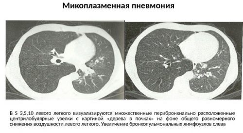 Рентген микоплазменной пневмонии