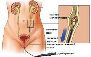 Воспаление ( уретрит ) мочевого канала у женщин