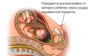 Заражение при беременности