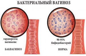 Бактерии при баквагинозе