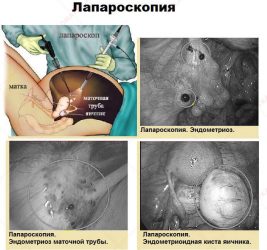 Лапароскопическая операция