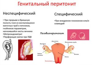 Генитальный перитонит