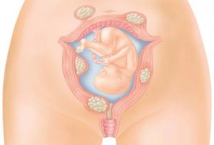 Миоматозные узлы при беременности