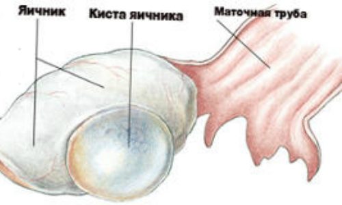Проявление серозной кисты яичника