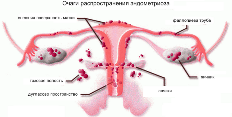Эндометриоз матки причины