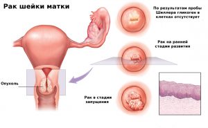 Развитие опухоли матки