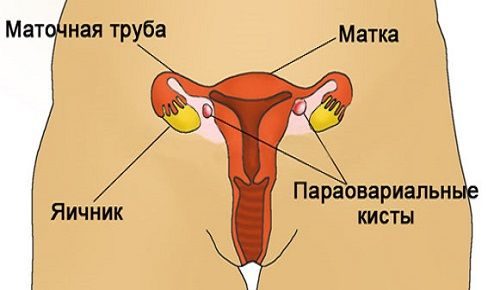 Развитие параовариальной кисты яичника