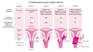 Стадии развития рака шейки матки
