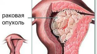 Раковая опухаль