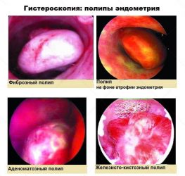 Разновидности полипов эндометрия