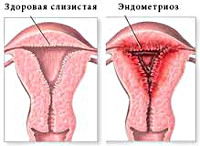 Проявление эндометриоза