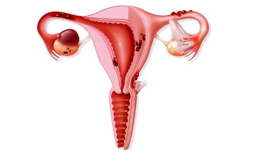 Развитие генитального эндометриоза