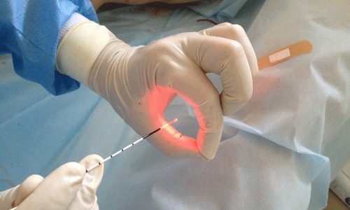Лазерное лечение простатита у мужчин