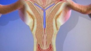 Схема лечения эндометриоза Миреной