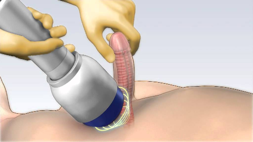 Erectile Dysfunction Porn Video