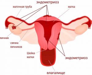Распространение эндометриоза