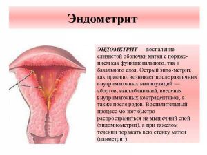 Проявление эндометрита