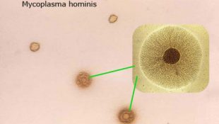 Mycoplasma hominis