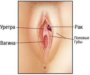 Раковая опухоль на половых губах