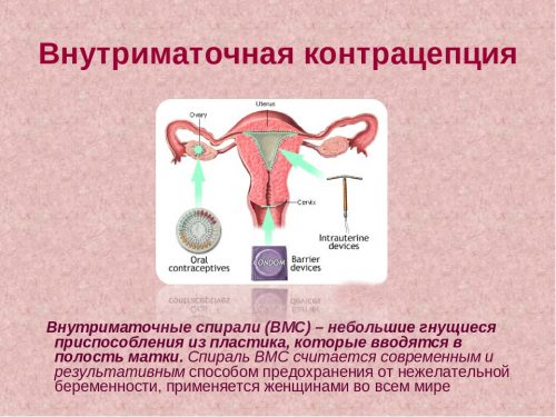 Внутриматочная контрацепция