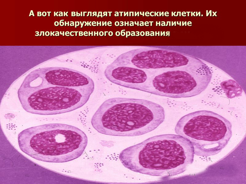 Атипичные клетки в цитологии что это. Атиписные клетки вмокроте. Атипические клетки исследование.
