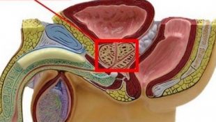 Диффузные изменения предстательной железы