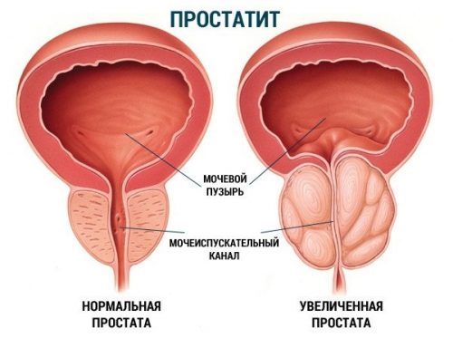 Схема простатита