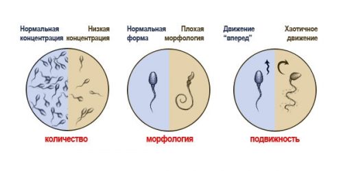 Патологии сперматозоидов
