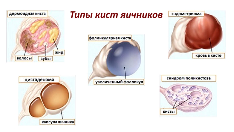 Образование округлое в яичнике. Эндометриоидная киста (вид на лапароскопии). Фолликулярная киста операция. Цистаденома и киста яичников. Киста яичника функциональная и эндометриозная.