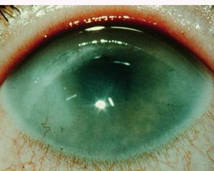 Поздний сифилис глаз