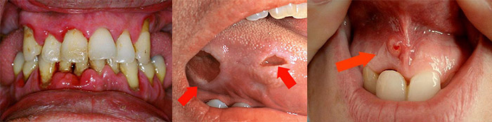 Виды сифилиса во рту