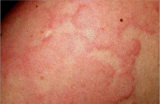 сыпь при ИППП: вирусный гепатит